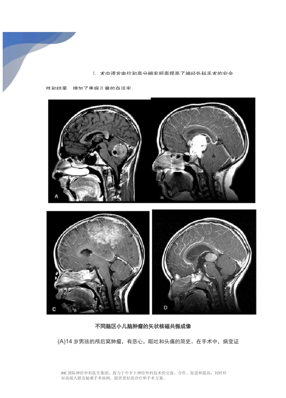 儿童低级别与高级别胶质瘤的诊断治疗_第3页
