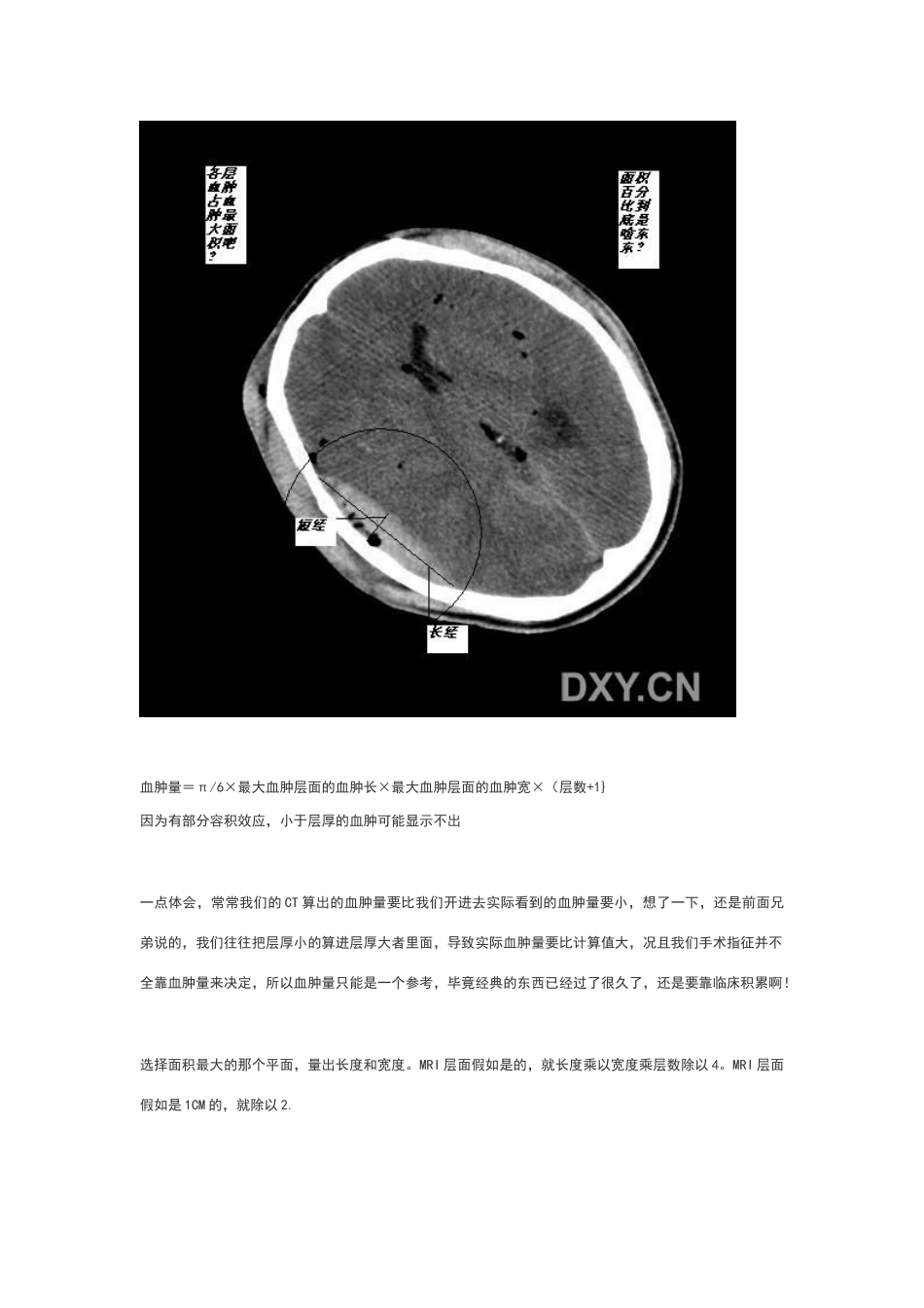 脑出血量的计算公式_第3页