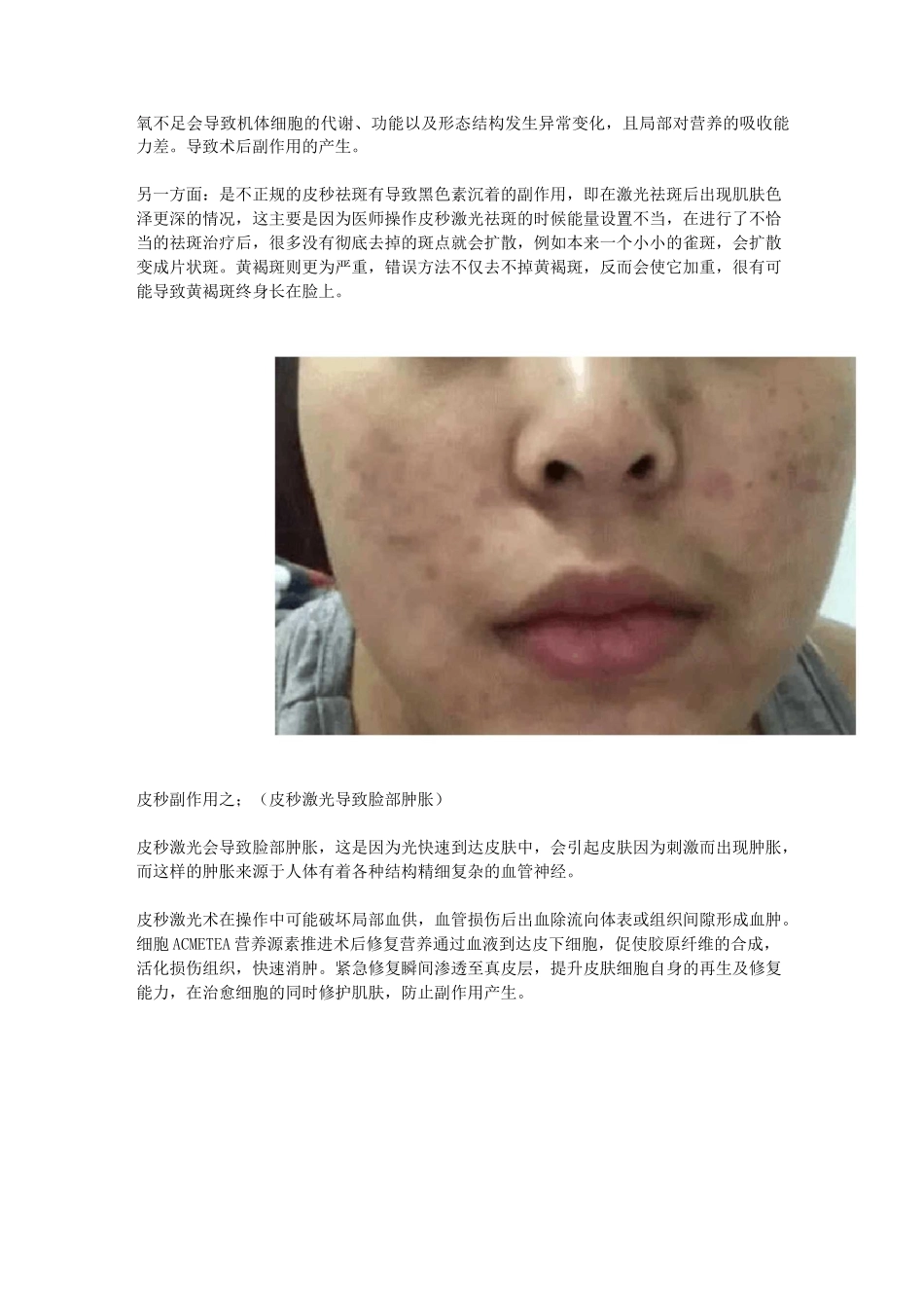 皮秒后反黑处理;做了皮秒要注意什么？请仔细阅读!_第2页