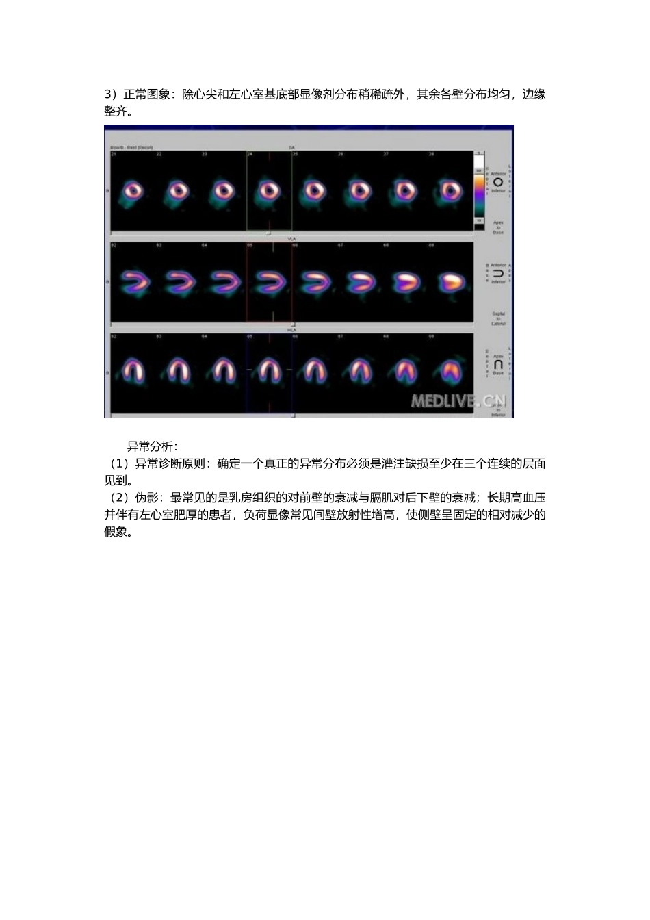 心脏ECT适应症与图像分析报告_第2页