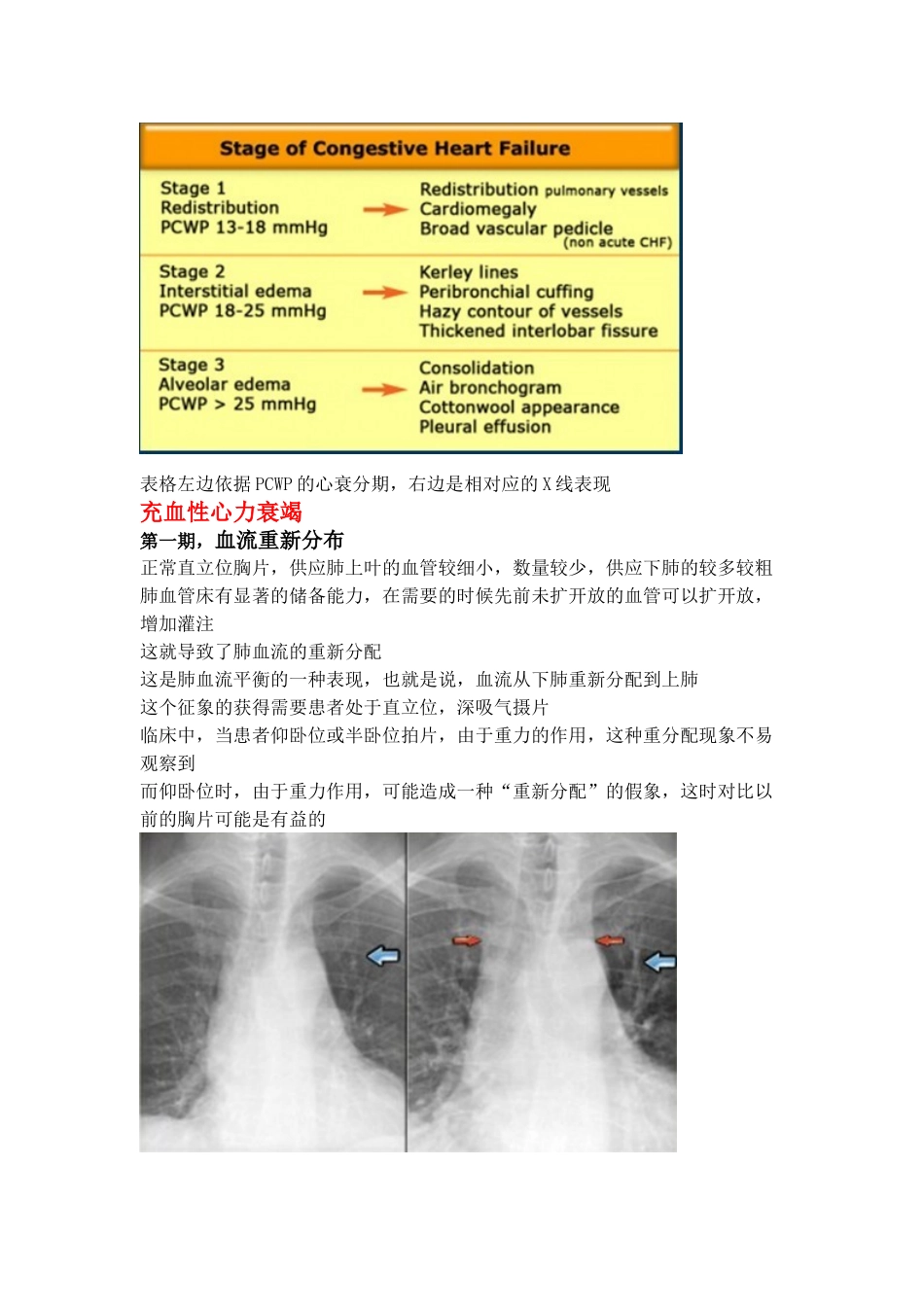 心衰的胸部X线征象_第2页
