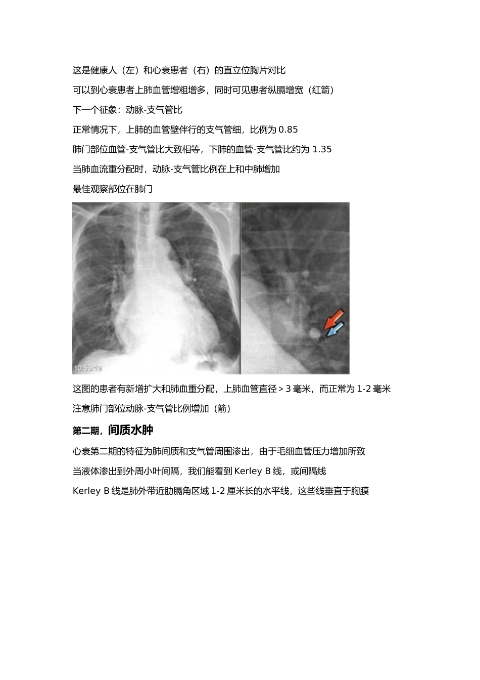 心衰的胸部X线征象_第3页