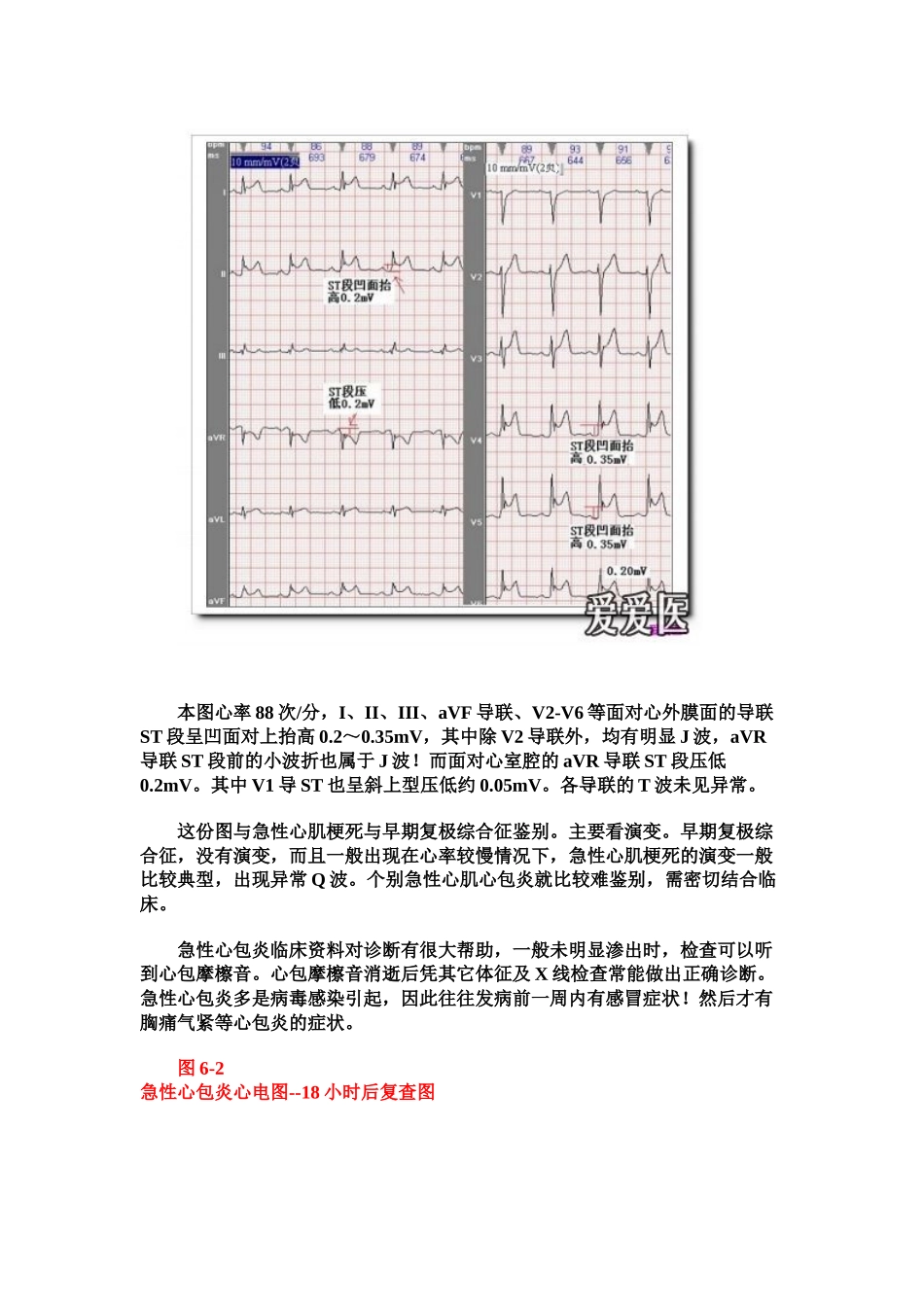 第二十六讲心包与胸腔疾病及电解质异常的心电图诊断_第2页