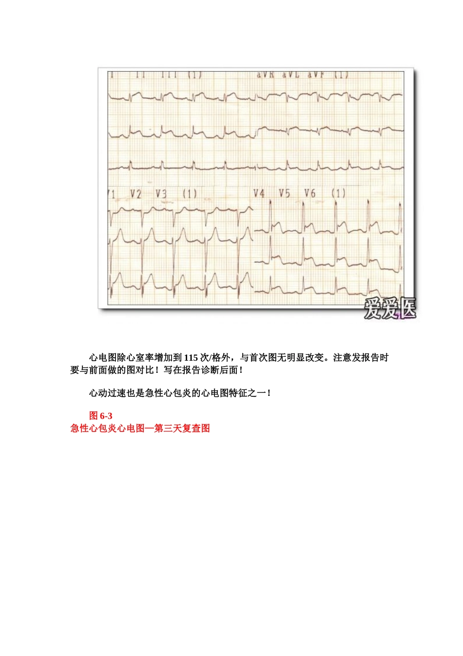 第二十六讲心包与胸腔疾病及电解质异常的心电图诊断_第3页