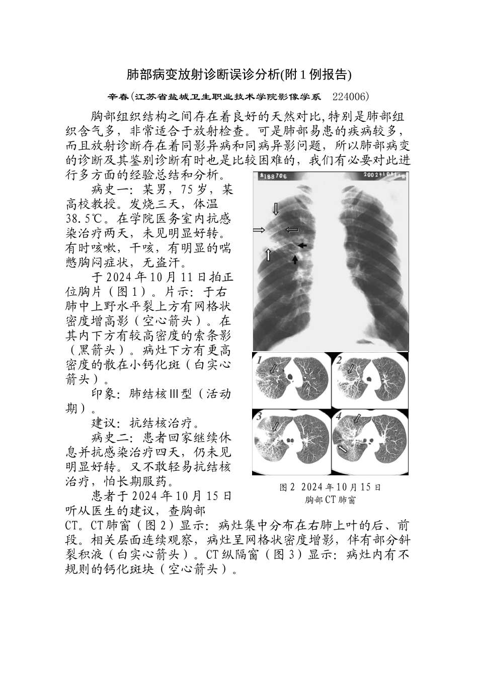 肺部病变放射诊断误诊分析doc-肺部病变放射诊断误诊一例_第1页