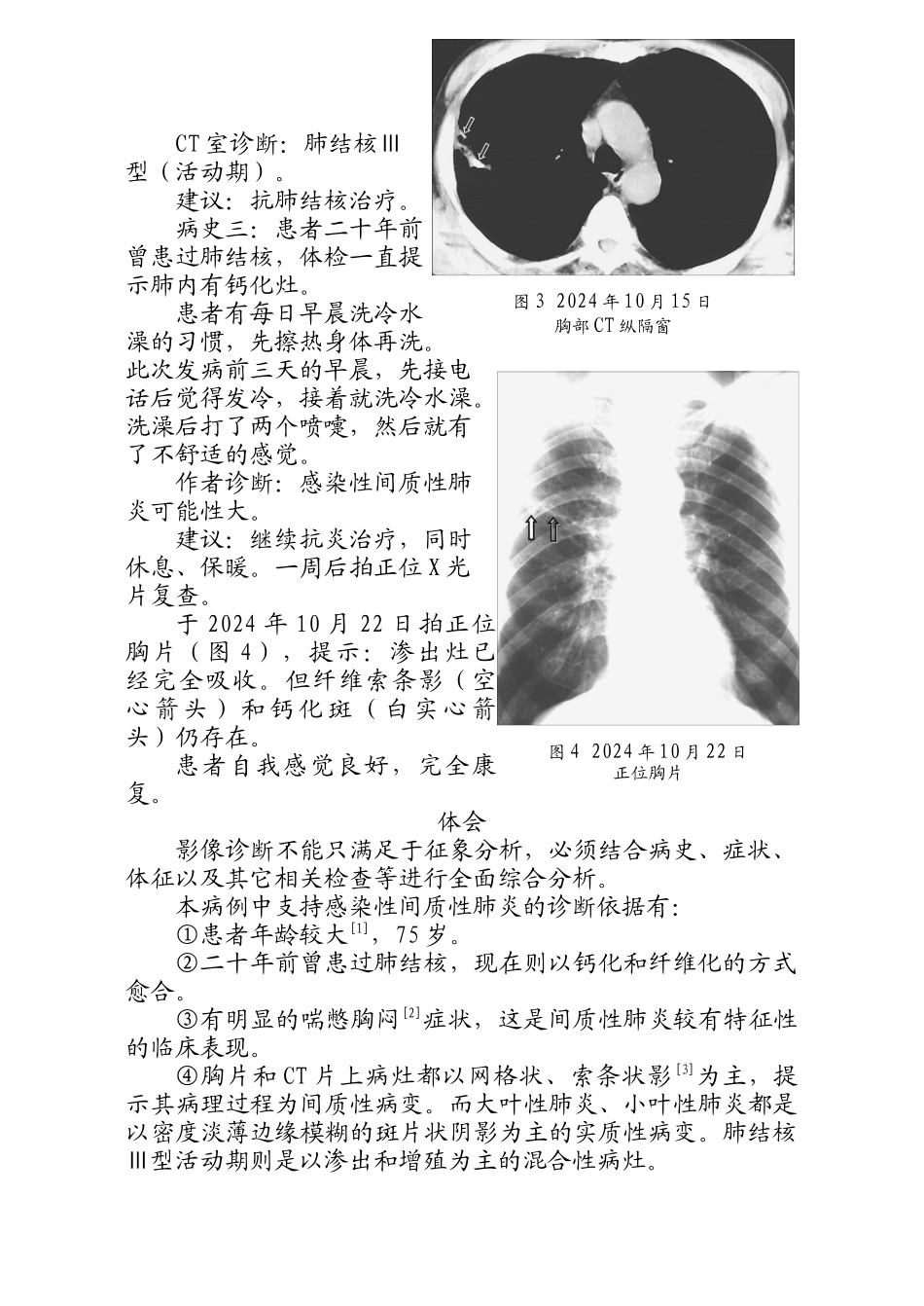 肺部病变放射诊断误诊分析doc-肺部病变放射诊断误诊一例_第2页