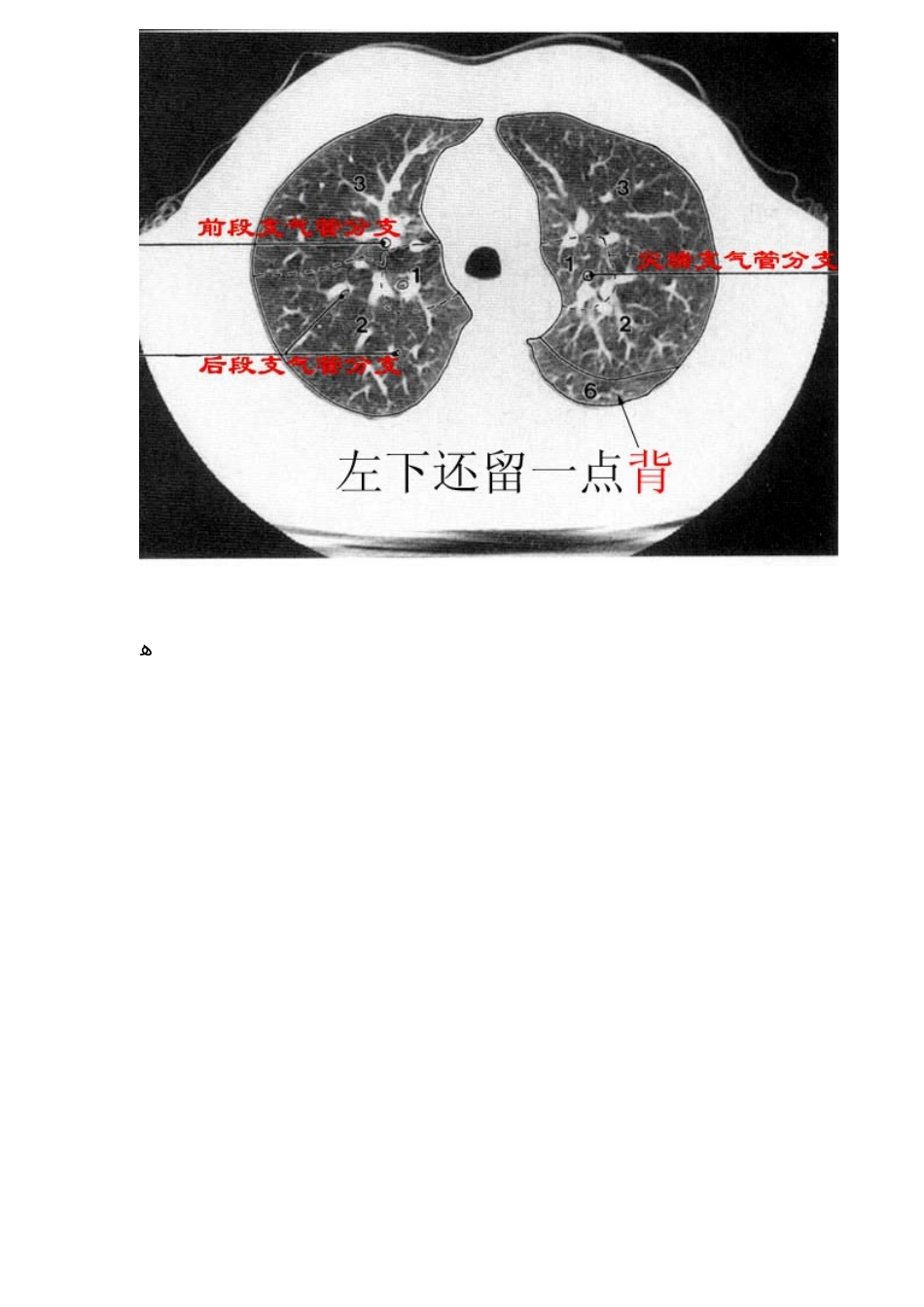 CT肺的分叶分段_第3页