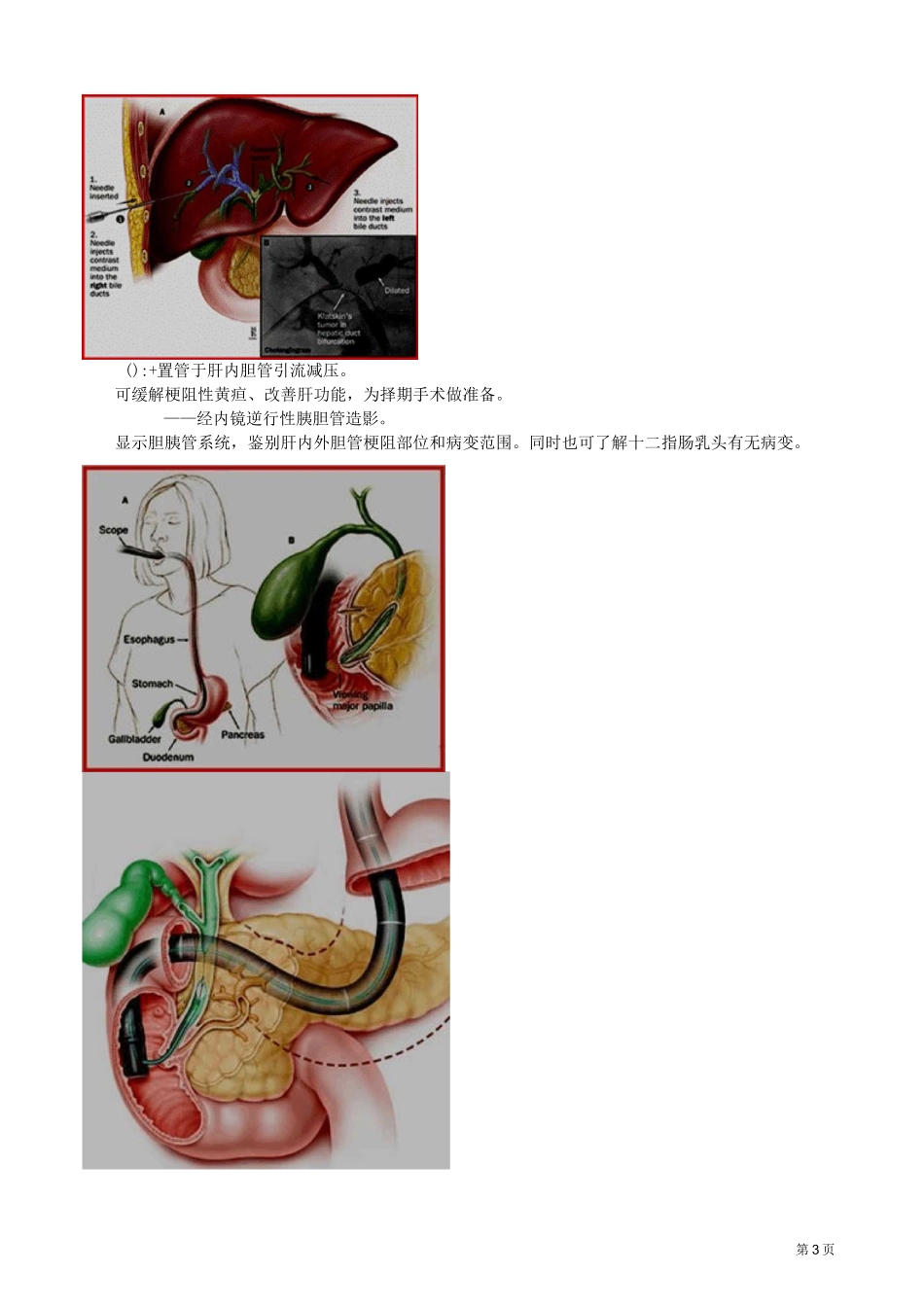 主管护师外科讲义：第二十四章 胆道疾病病人的护理_第3页