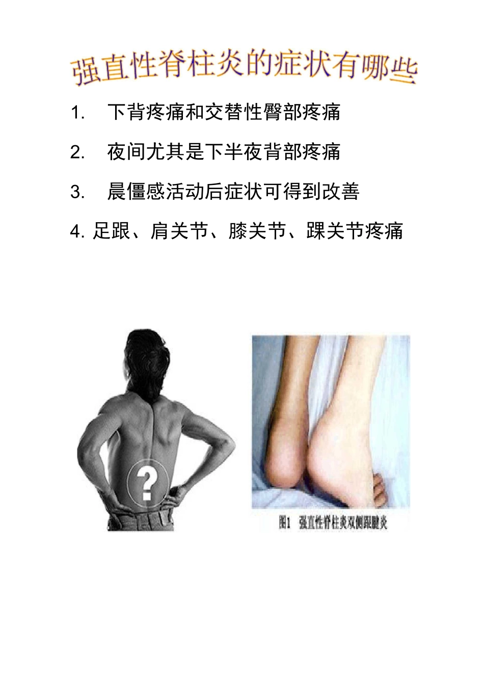 强直性脊柱炎健康宣教_第2页