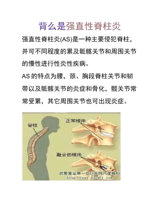 强直性脊柱炎健康宣教
