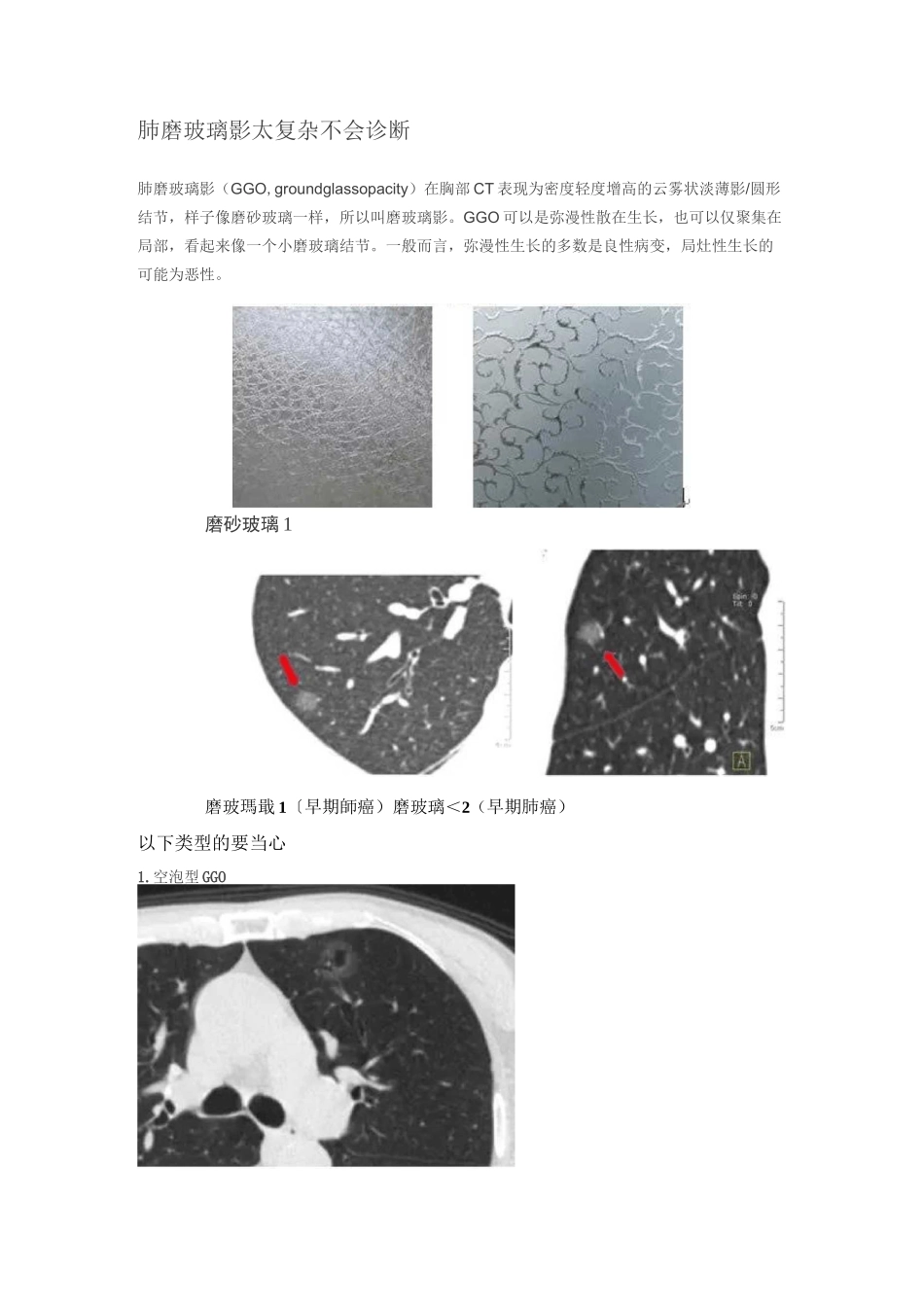 肺磨玻璃影太复杂不会诊断_第1页
