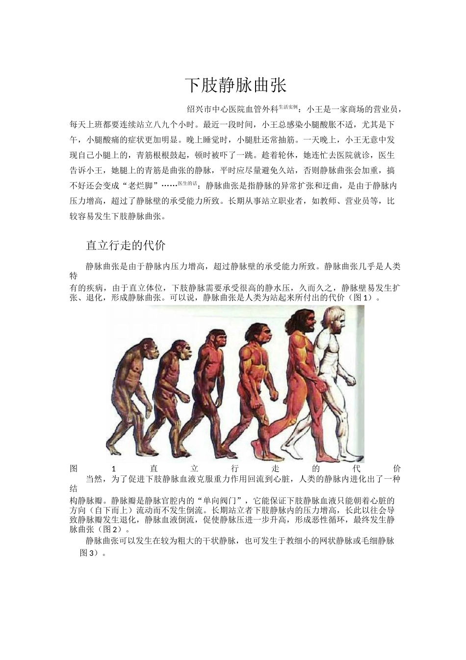 下肢静脉曲张_第1页