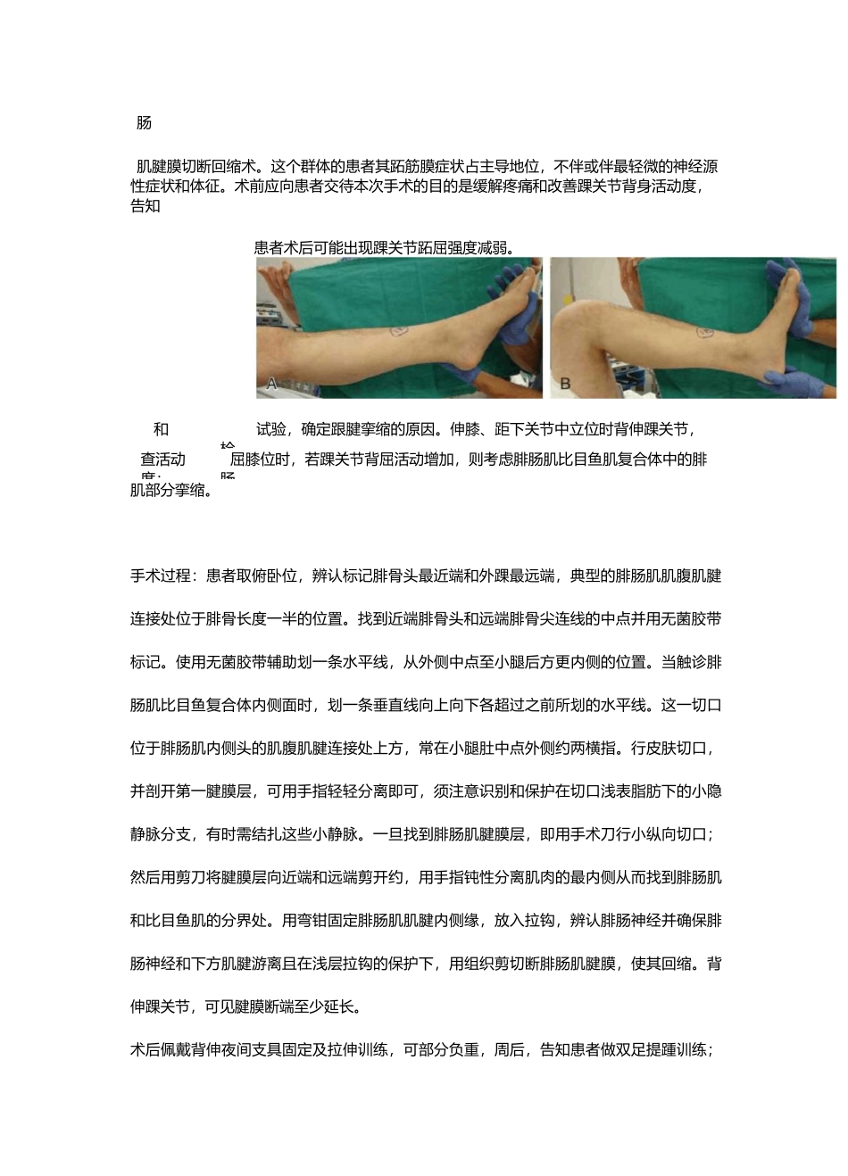 腓肠肌腱膜松解_第2页