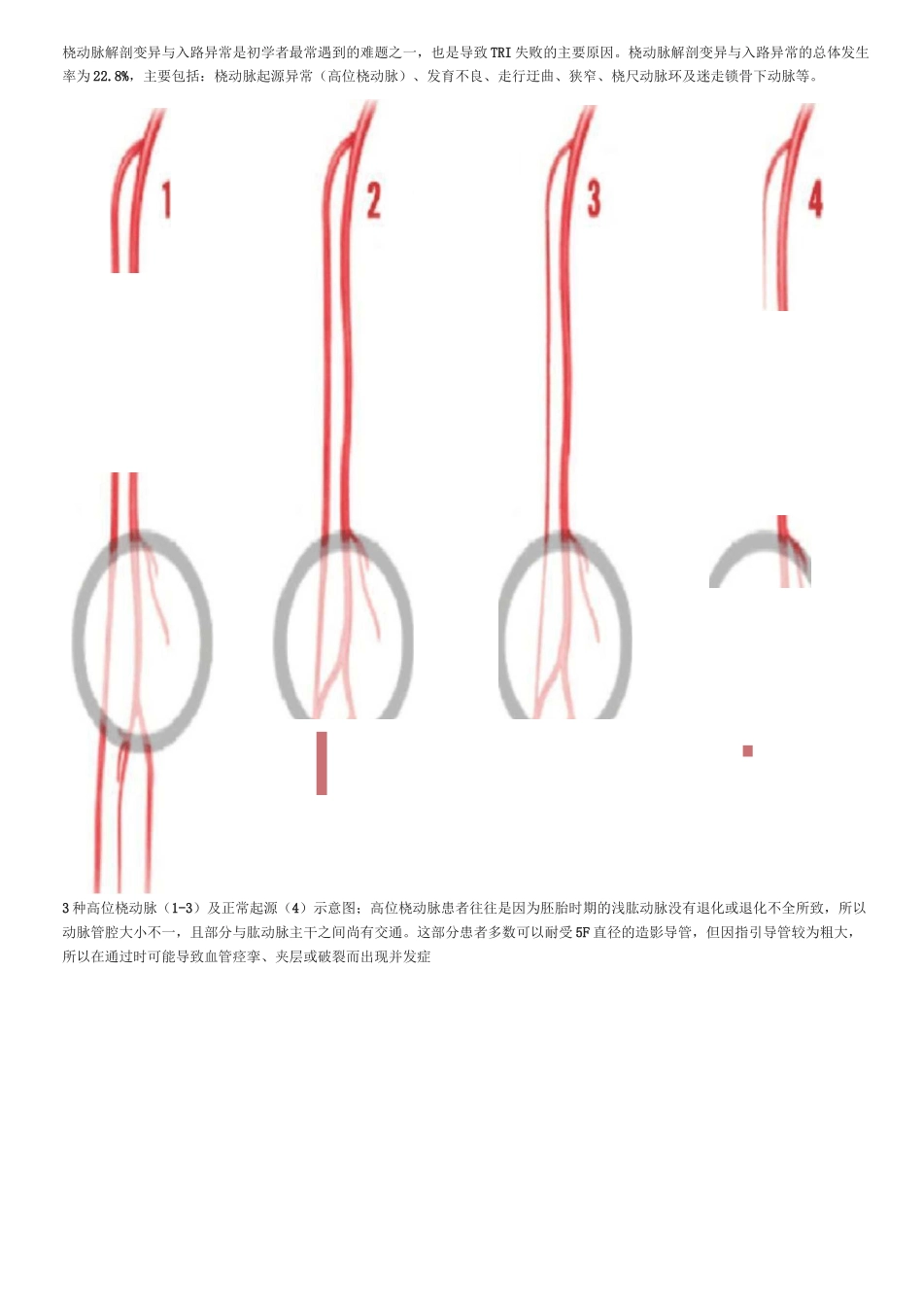 手把手教你桡动脉穿刺技巧(精美图文)_第3页