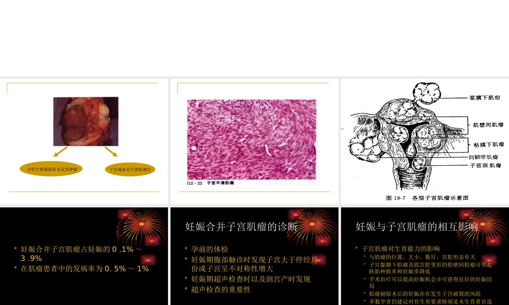 妊娠合并子宫肌瘤的诊断与处理