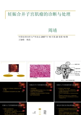 妊娠合并子宫肌瘤的诊断与处理