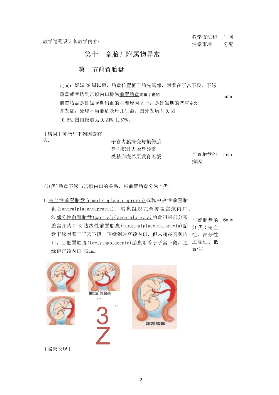 临床医学前置胎盘教案_第3页