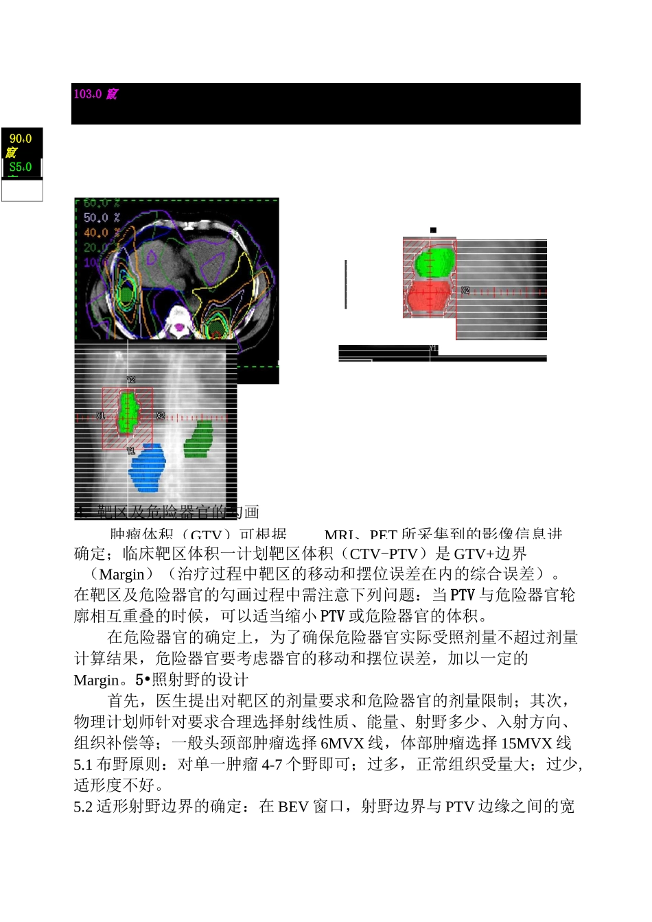 三维适形放射治疗过程流程_第3页