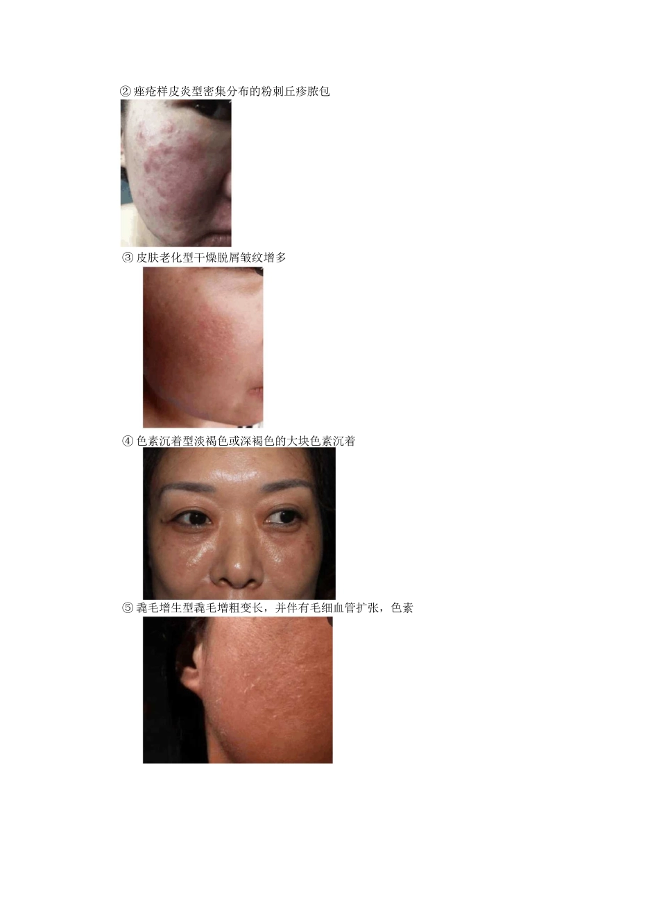 激素依赖性皮炎_第3页