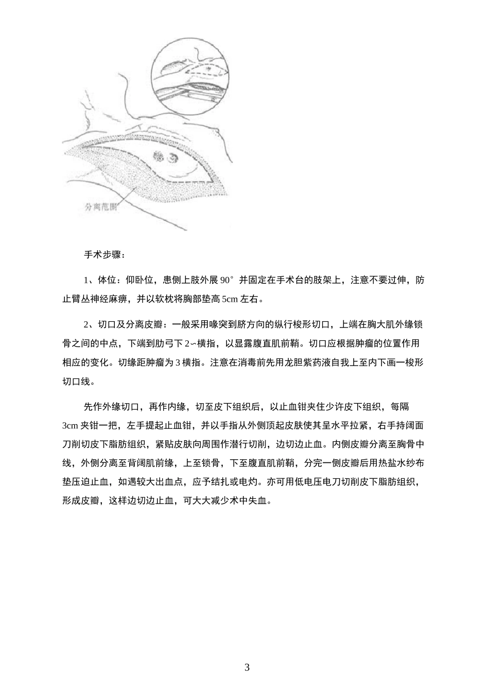 乳腺癌手术步骤_第2页