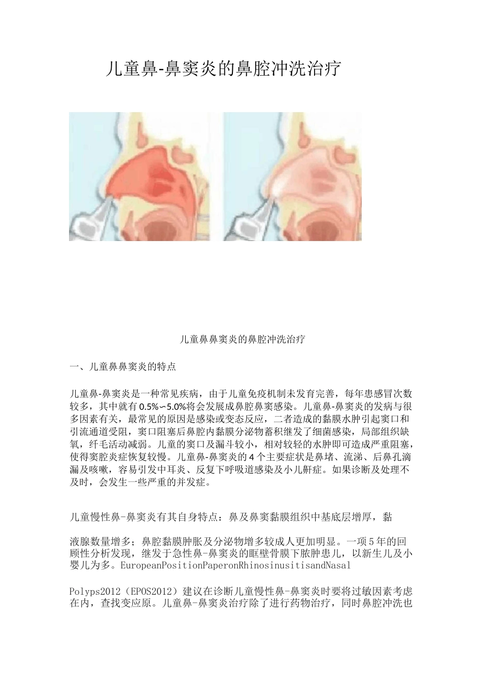 儿童鼻-鼻窦炎的鼻腔冲洗治疗_第1页