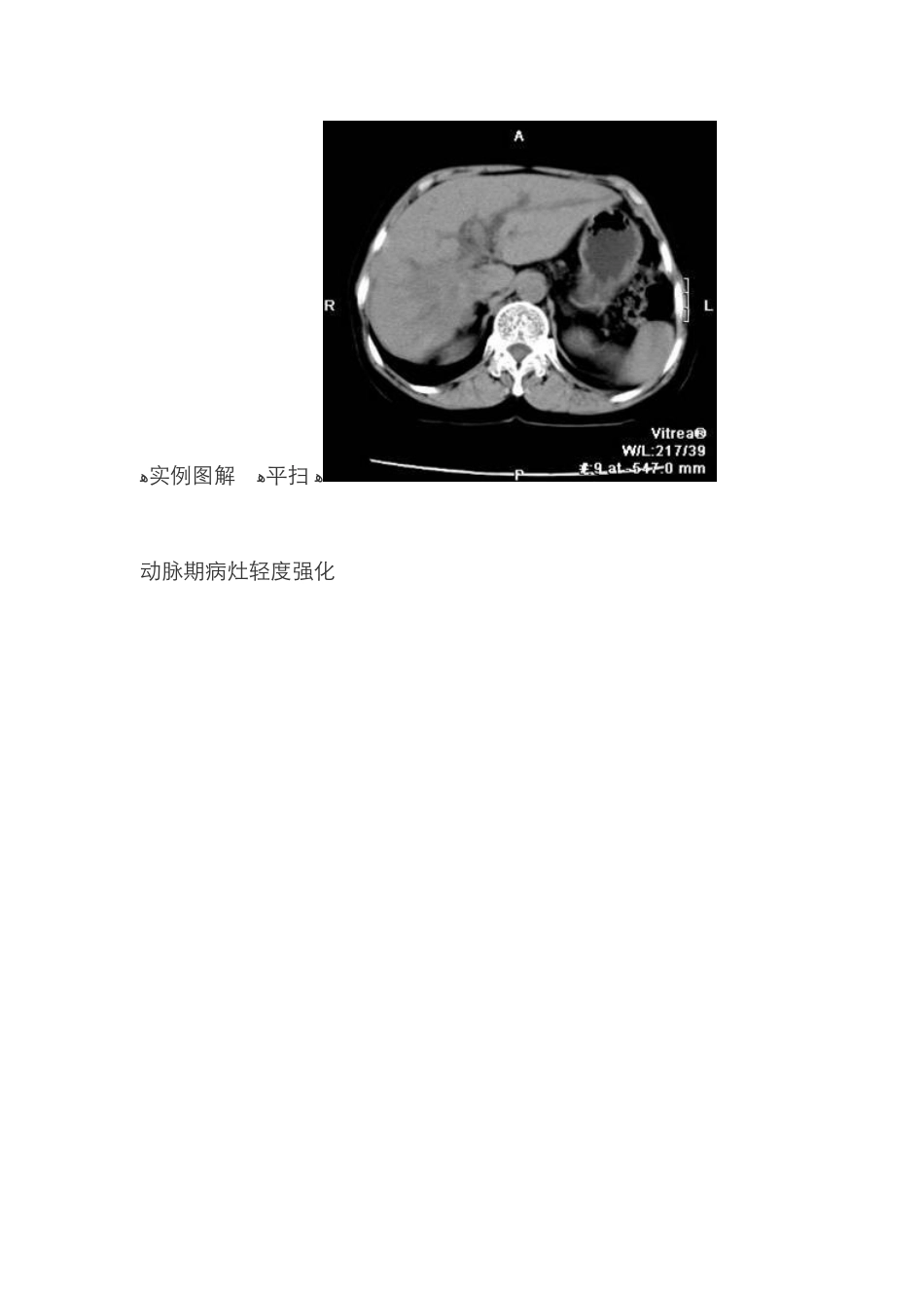 胆管细胞癌CT强化特点及其病理基础_第3页
