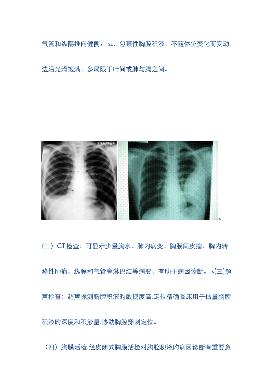 胸腔积液教案_第3页