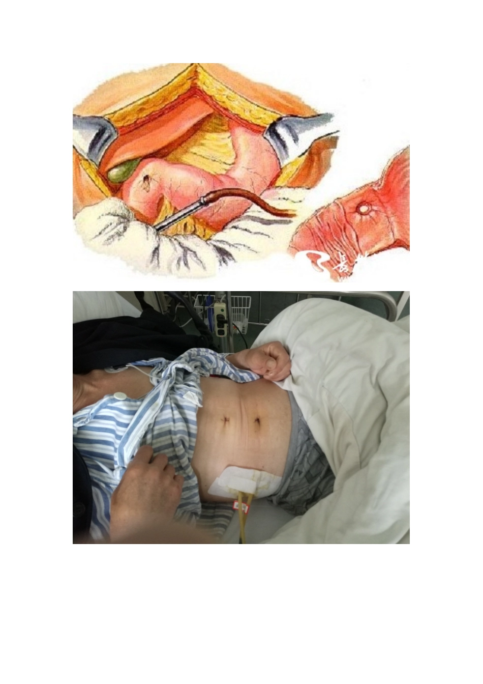 腹腔镜下胃穿孔修补术_第3页