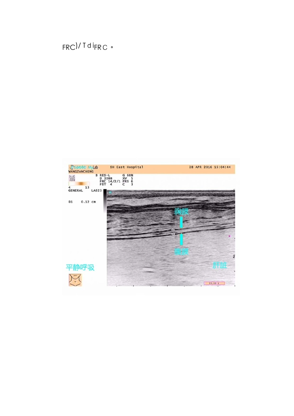 膈肌超声新版_第3页