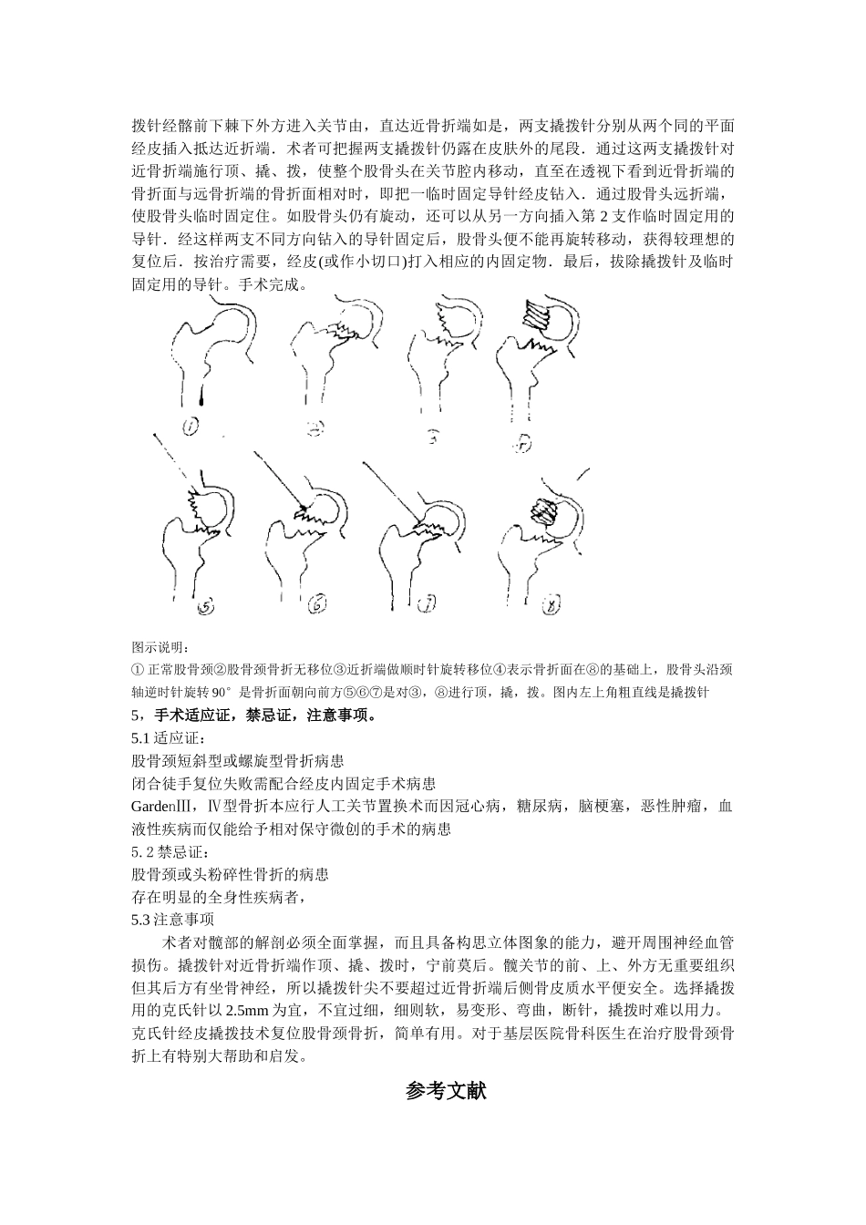齐鲁医学克氏针撬拨技术在闭合复位股骨颈骨折中的运用_第2页