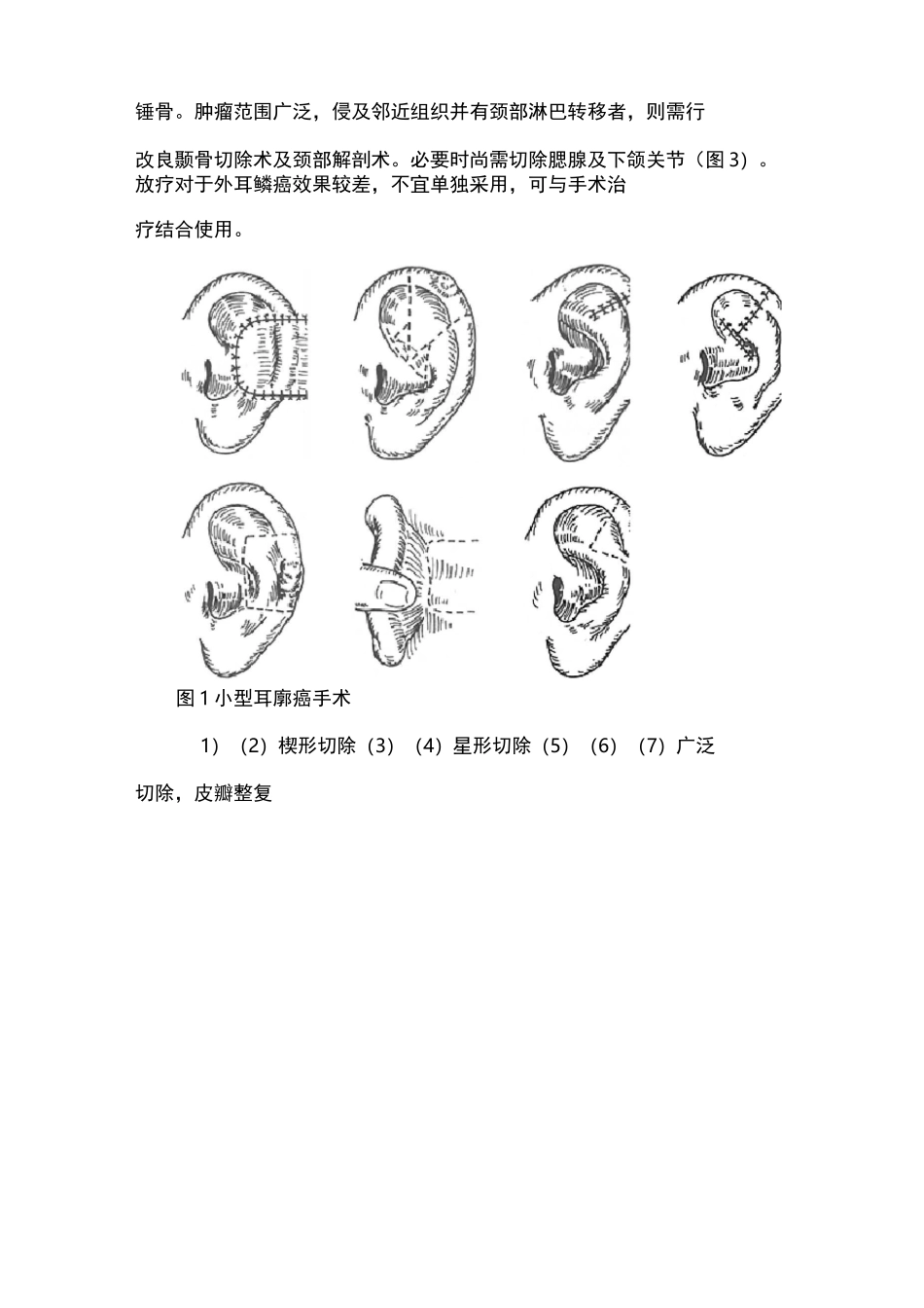耳部恶性肿瘤_第2页