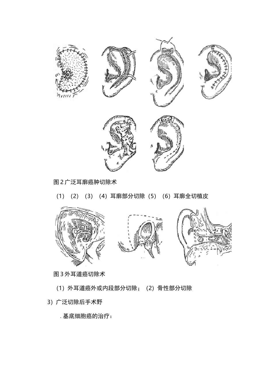 耳部恶性肿瘤_第3页