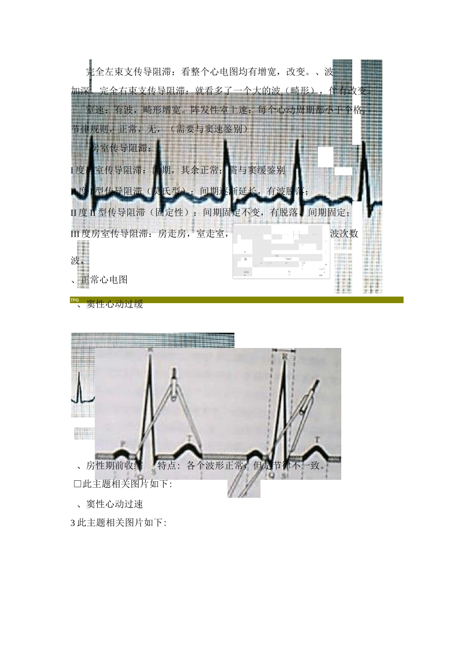 常见心律失常的心电图讲解资料_第2页