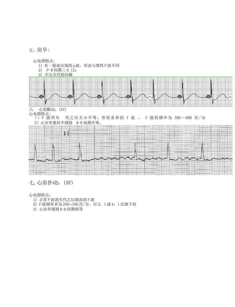 常用20种异常心电图与特点_第3页