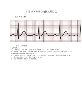 常用20种异常心电图与特点