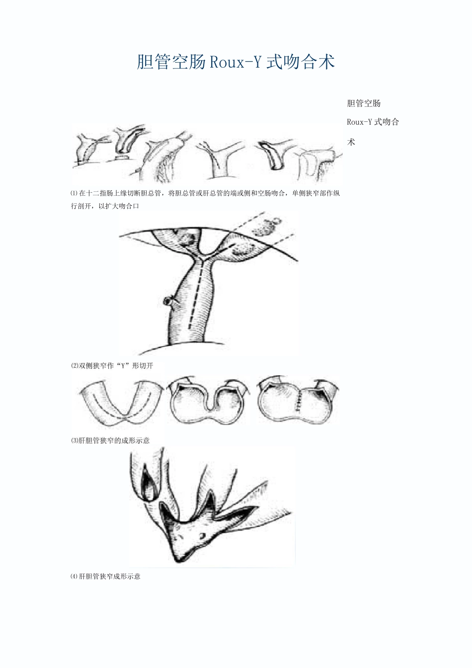 胆管空肠Roux-Y式吻合术_第1页