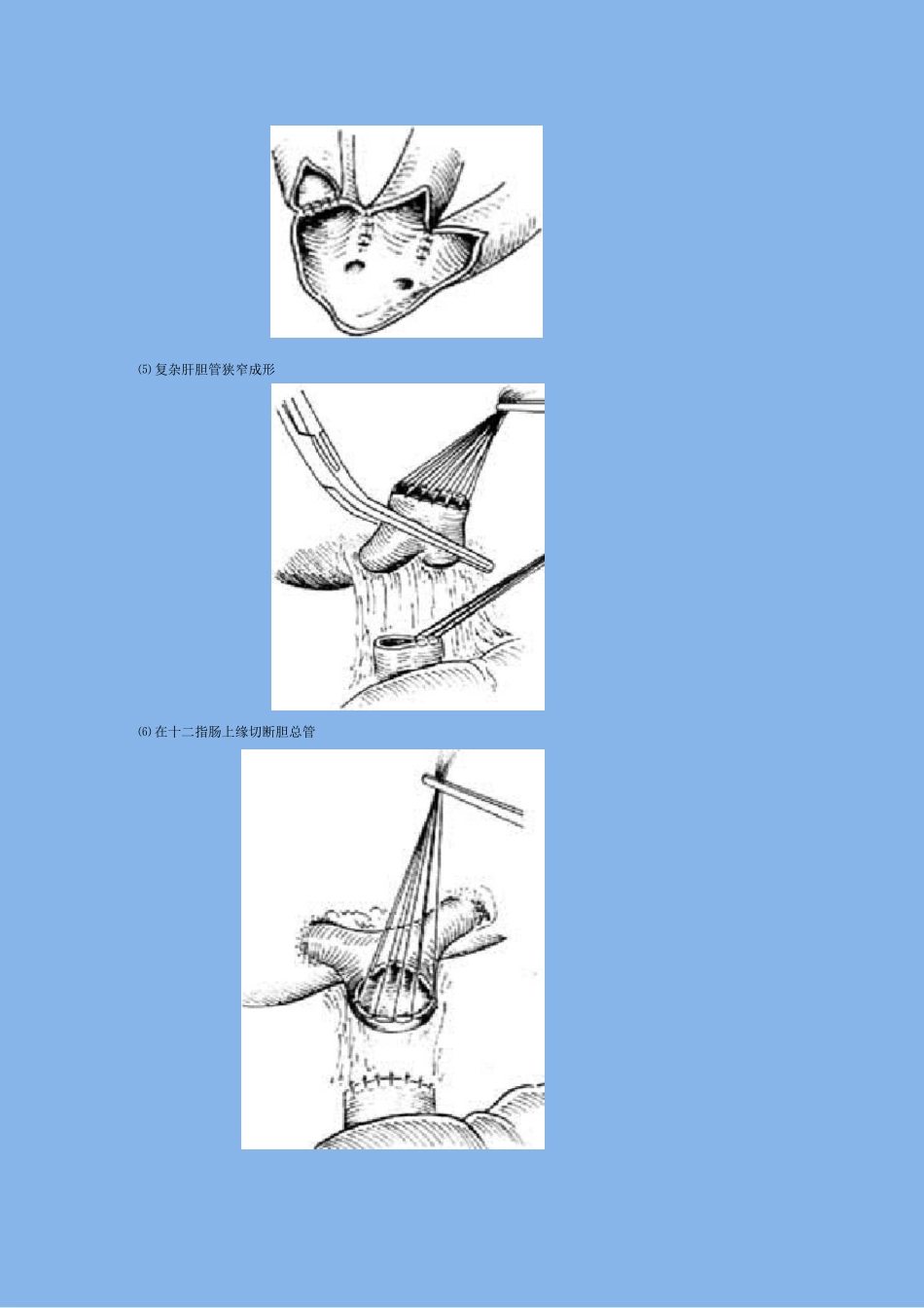 胆管空肠Roux-Y式吻合术_第2页