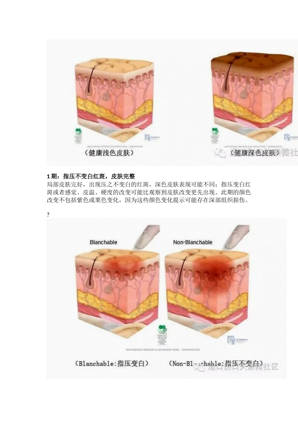 NPUAP最新版压力性损伤定义与分期_第2页