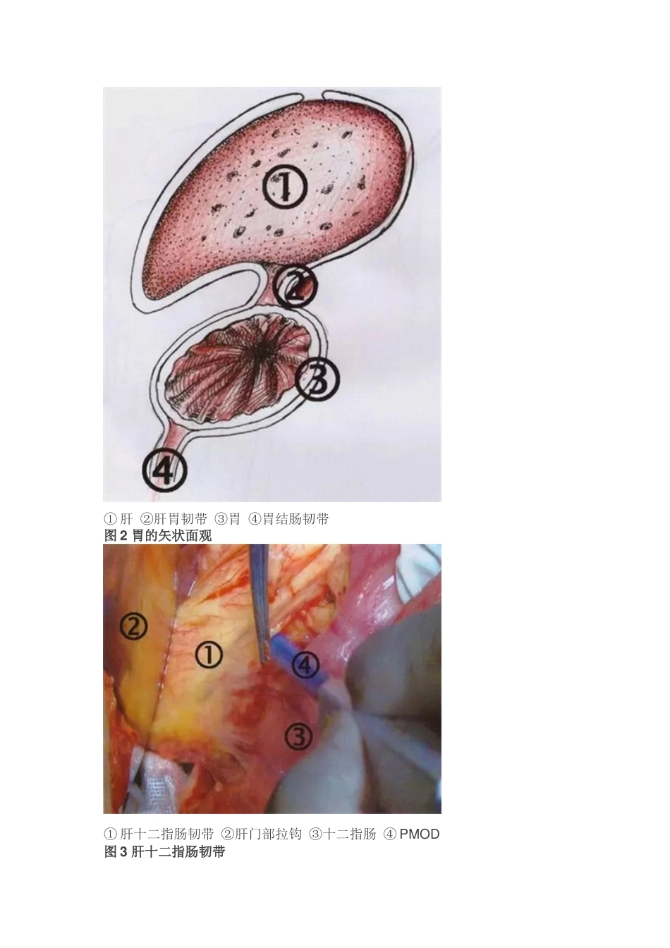 【手术图解】胃癌根治术：胃的毗邻和腹膜_第3页
