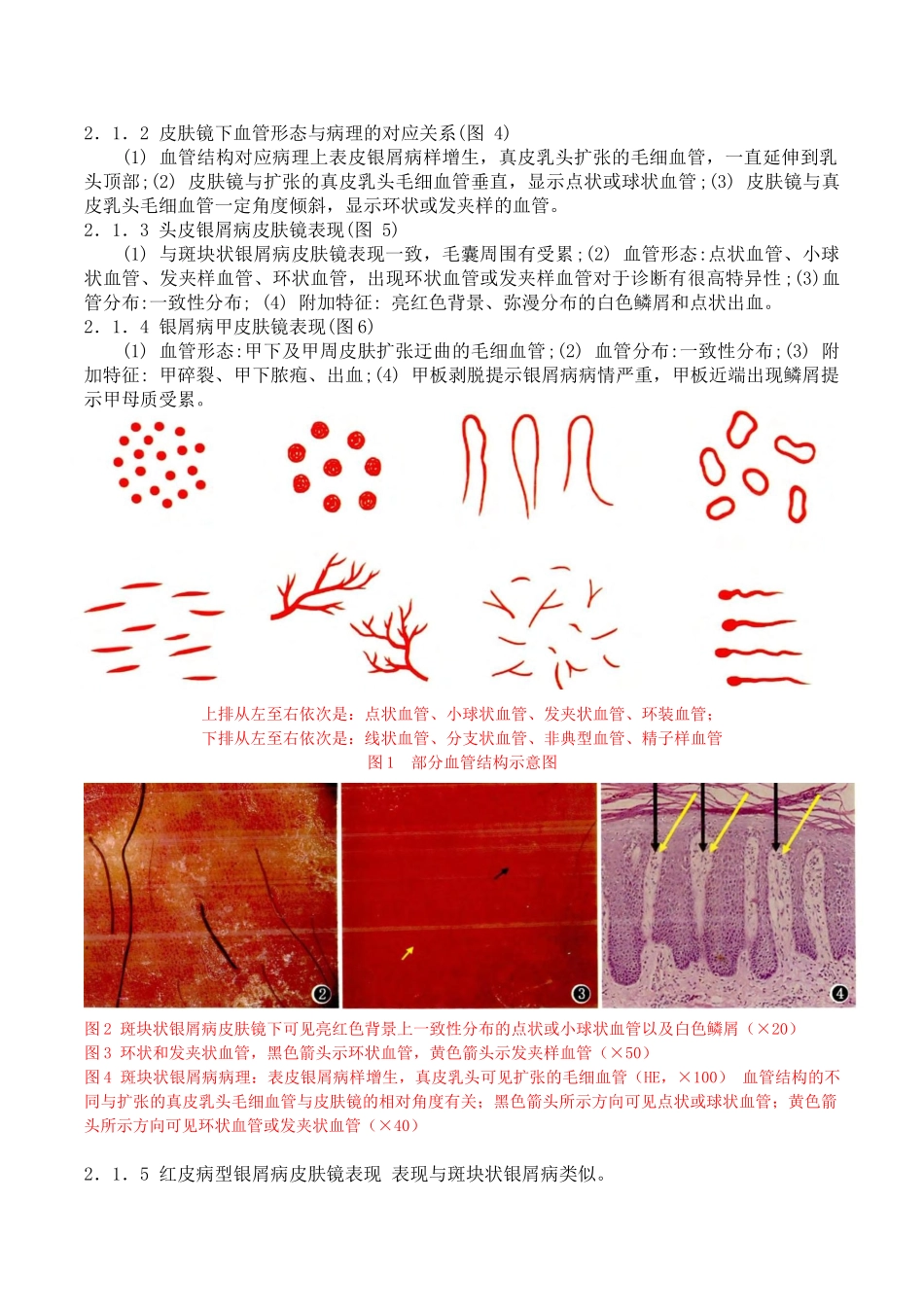 红斑鳞屑性皮肤病皮肤镜诊断专家共识_第2页