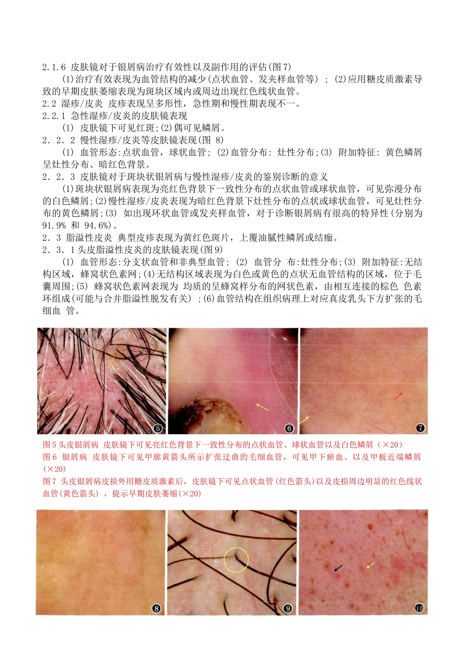 红斑鳞屑性皮肤病皮肤镜诊断专家共识_第3页