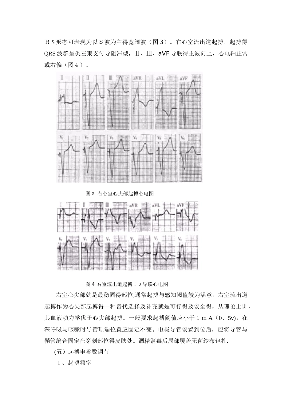 临时心脏起搏器的安置术_第2页
