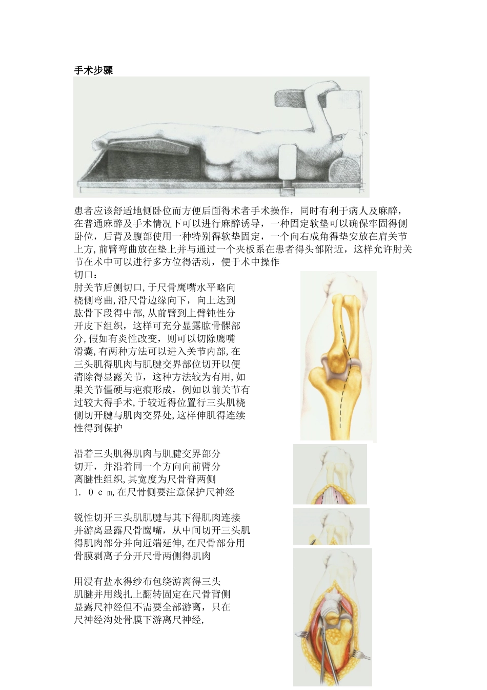 人工肘关节置换手术步骤_第1页
