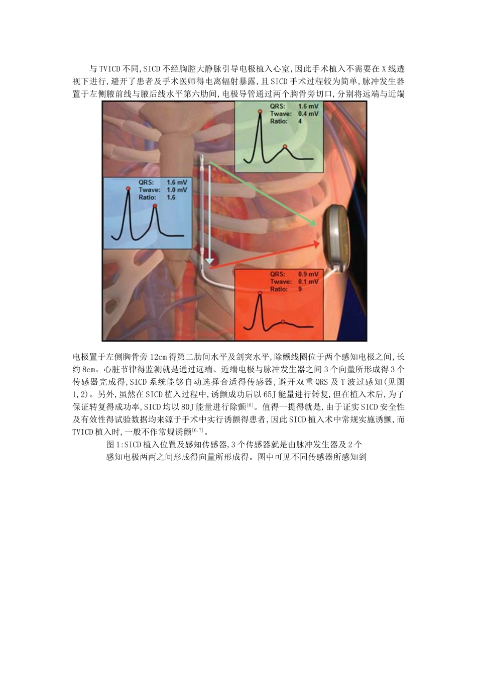 全皮下埋藏式心脏转复除颤器_第2页