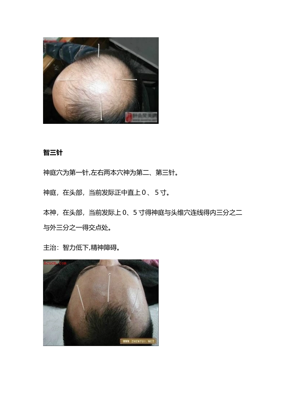 图文全解靳三针_第2页