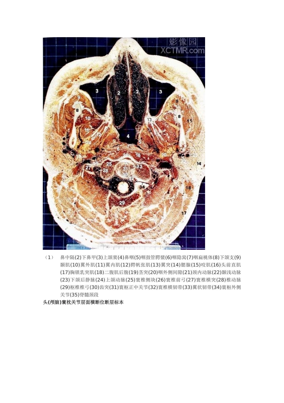 头颅横切面断层解剖_第2页