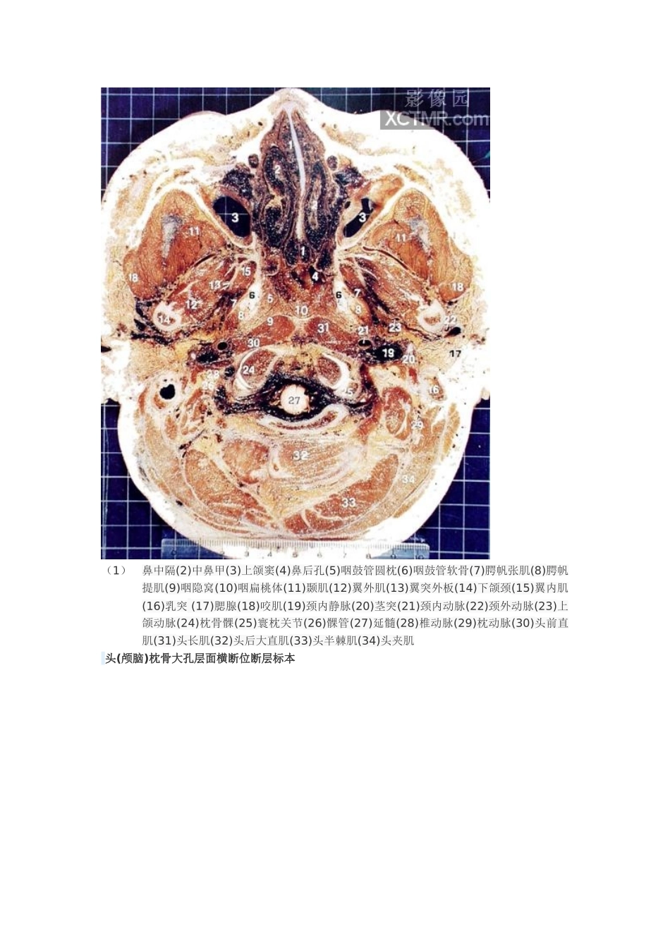 头颅横切面断层解剖_第3页