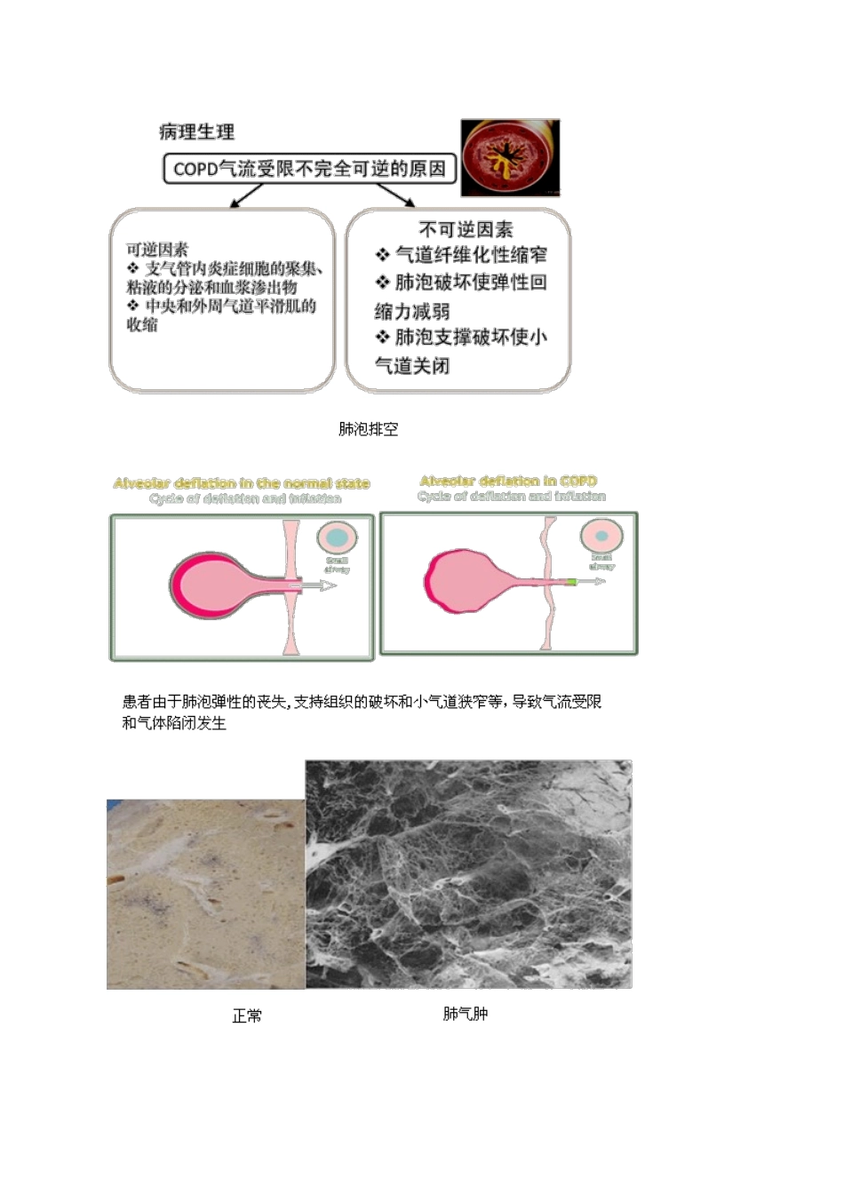 慢性阻塞性肺病和慢性肺源性心脏病_第2页