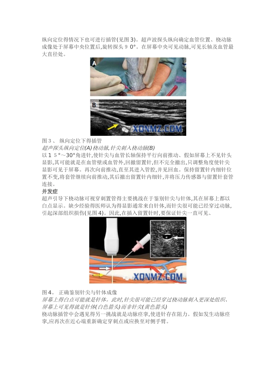 新英格兰医学杂志超声引导下桡动脉穿刺置管指南_第3页