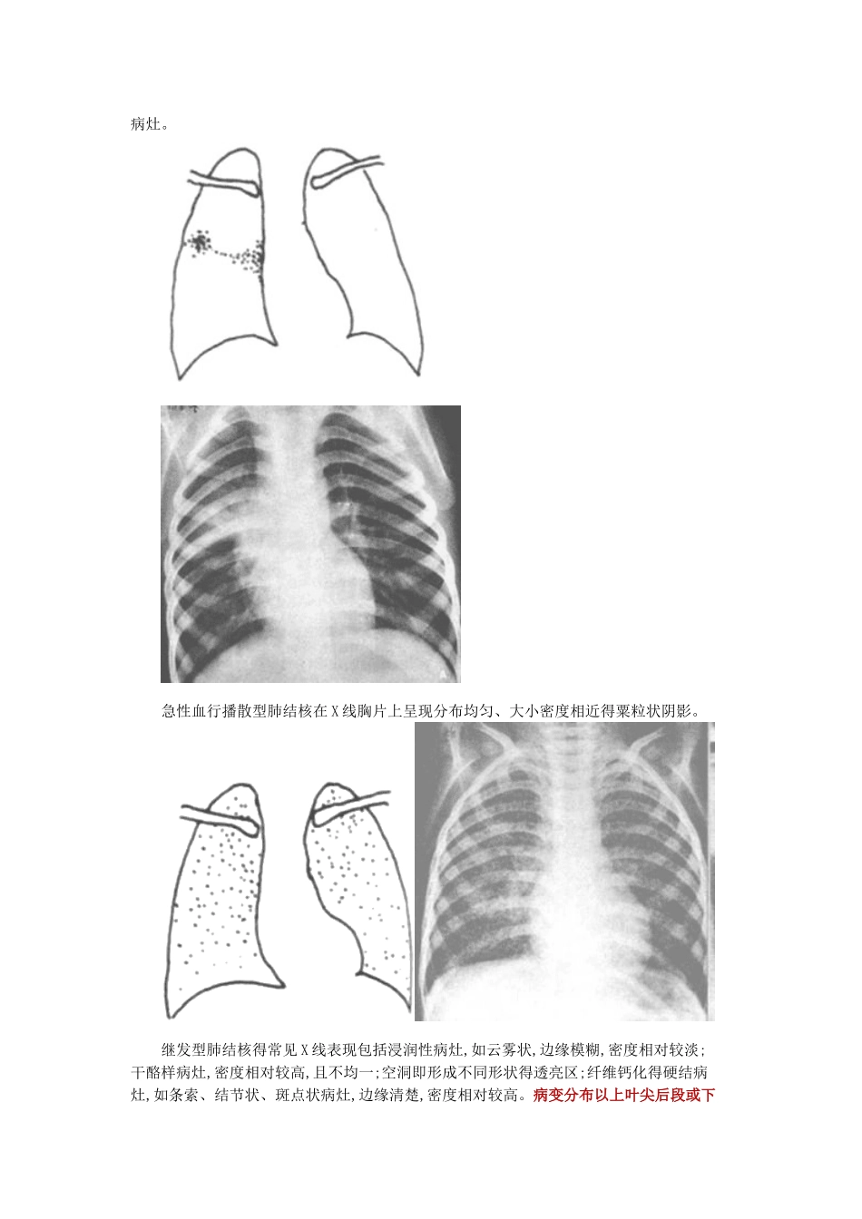 病例分析——肺结核_第2页